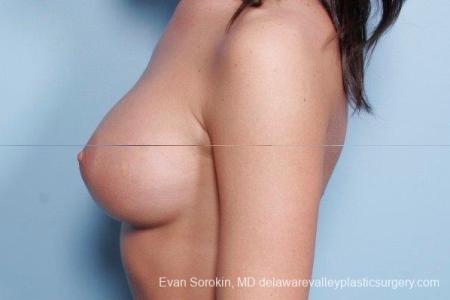 Philadelphia Breast Augmentation 8792 - After Image 5
