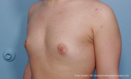 Philadelphia Breast Augmentation 9378 - Before Image 4