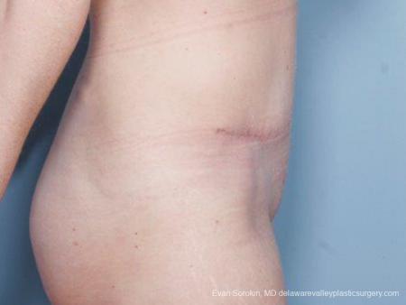 Philadelphia Abdominoplasty 9476 - After Image 3