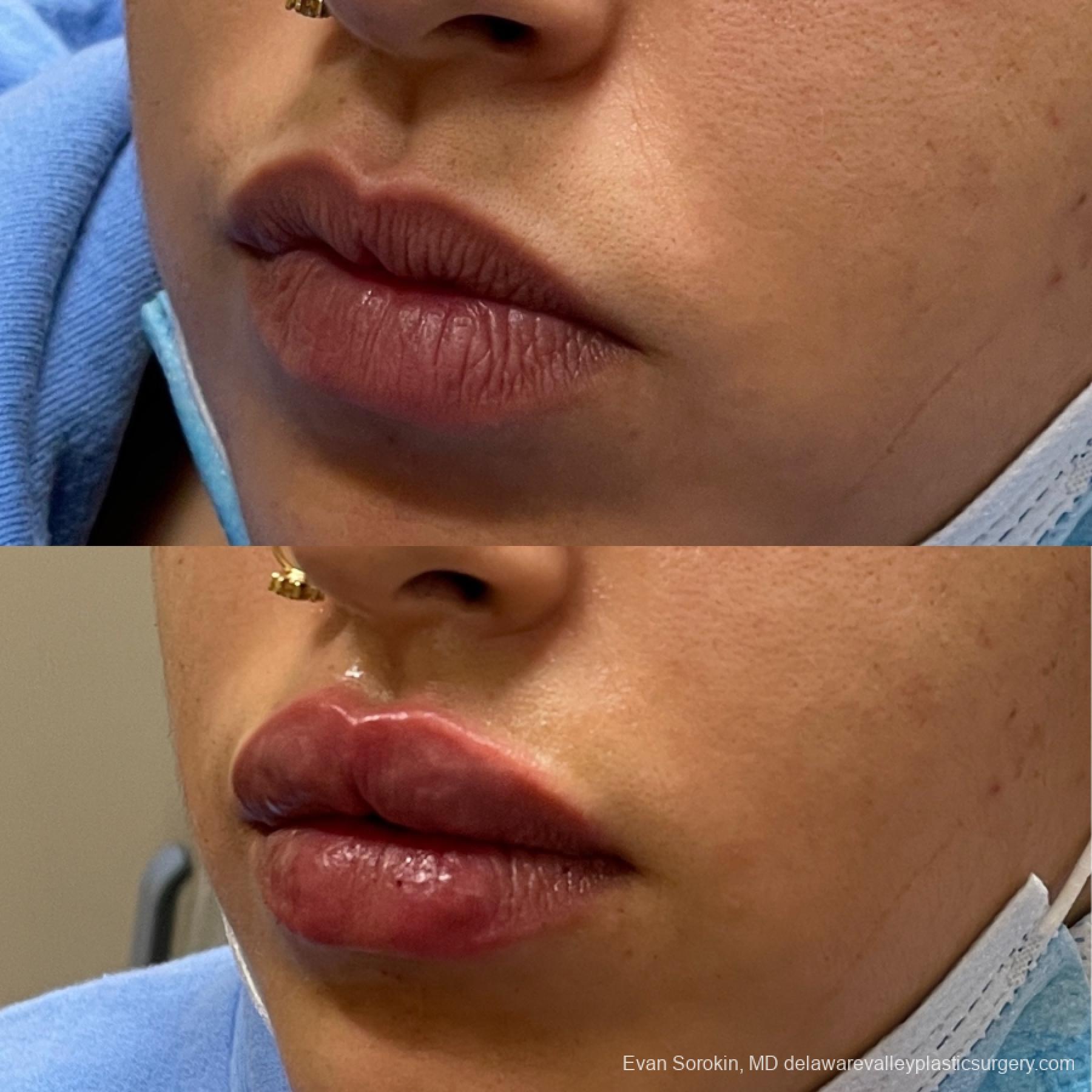 Lip Filler: Patient 4 - Before and After 3