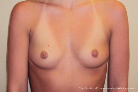 Philadelphia Breast Augmentation 8772 - Before Image 1