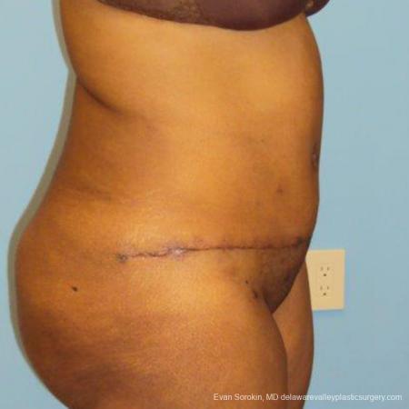 Philadelphia Abdominoplasty 9472 - After Image 3
