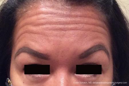 BOTOX® Cosmetic: Patient 2 - Before Image 1