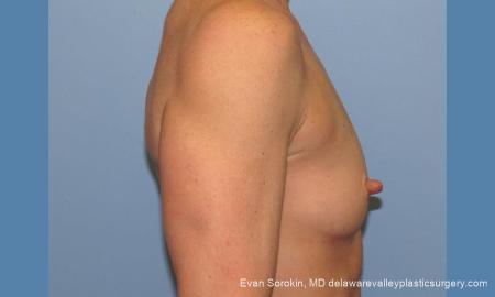 Philadelphia Breast Augmentation 9744 - Before Image 3