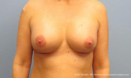 Philadelphia Breast Augmentation 9487 - After Image 1