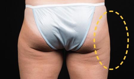 CoolSculpting®: Patient 10 - After Image 1