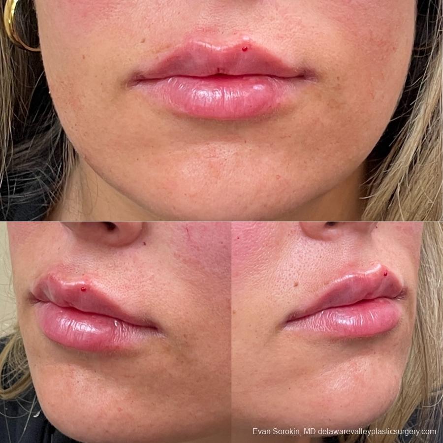Lip Augmentation: Patient 28 - Before and After 3