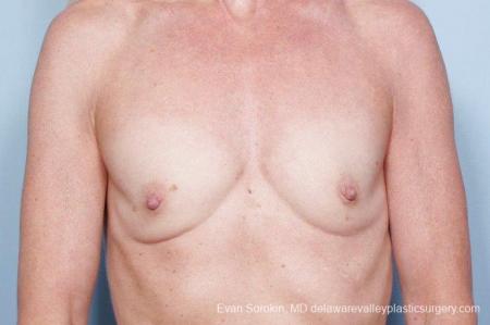 Philadelphia Breast Augmentation 9415 - Before Image 1