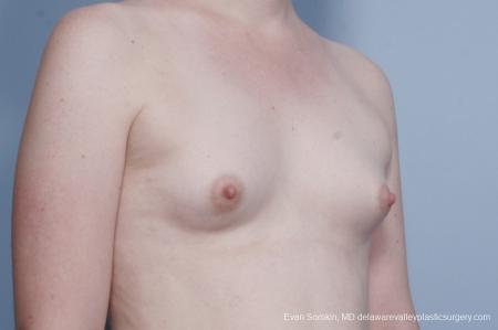 Philadelphia Top Surgery Male to Female 8642 - Before Image 2