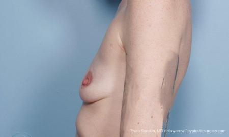 Philadelphia Breast Augmentation 8649 - Before and After Image 5