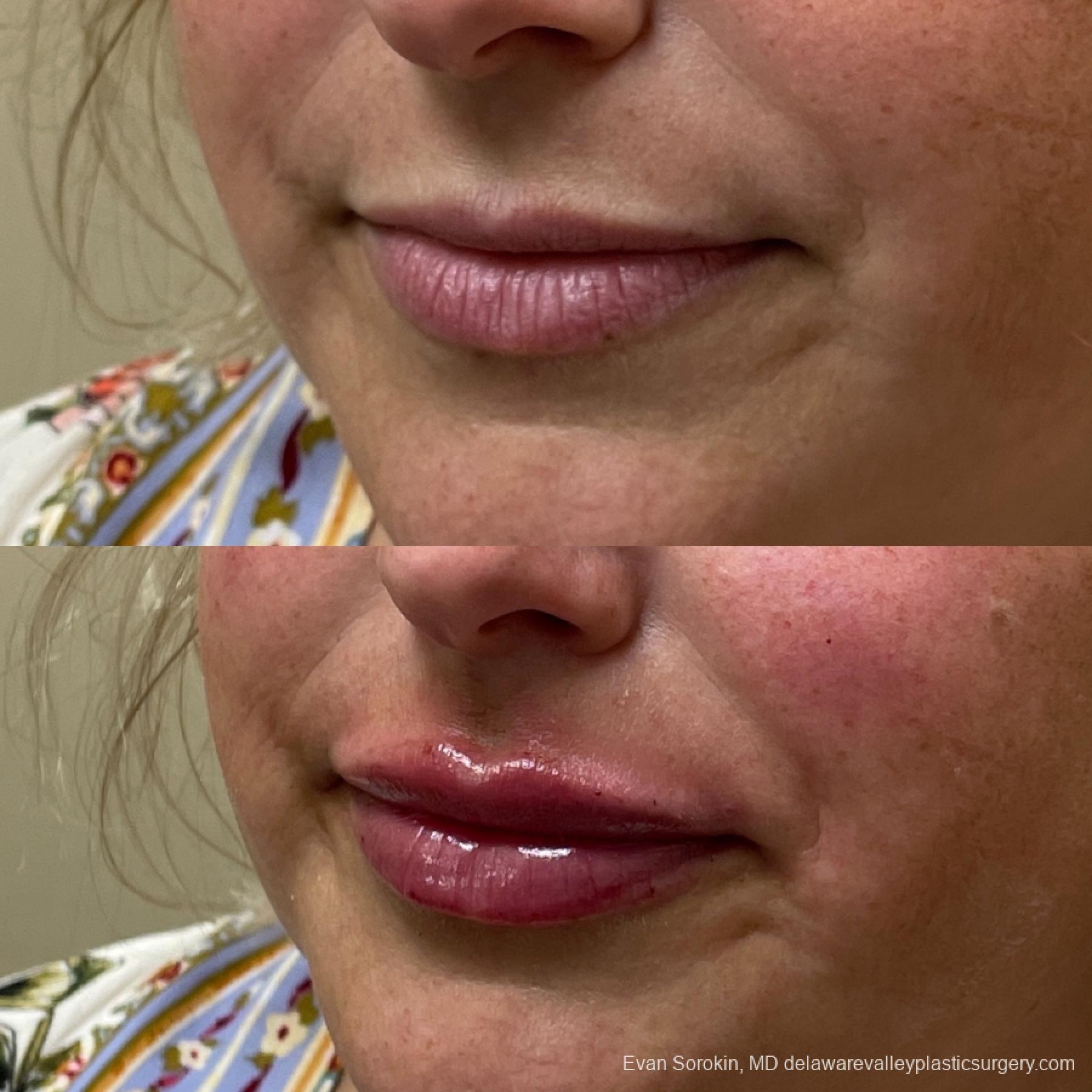 Lip Augmentation: Patient 19 - Before and After 3