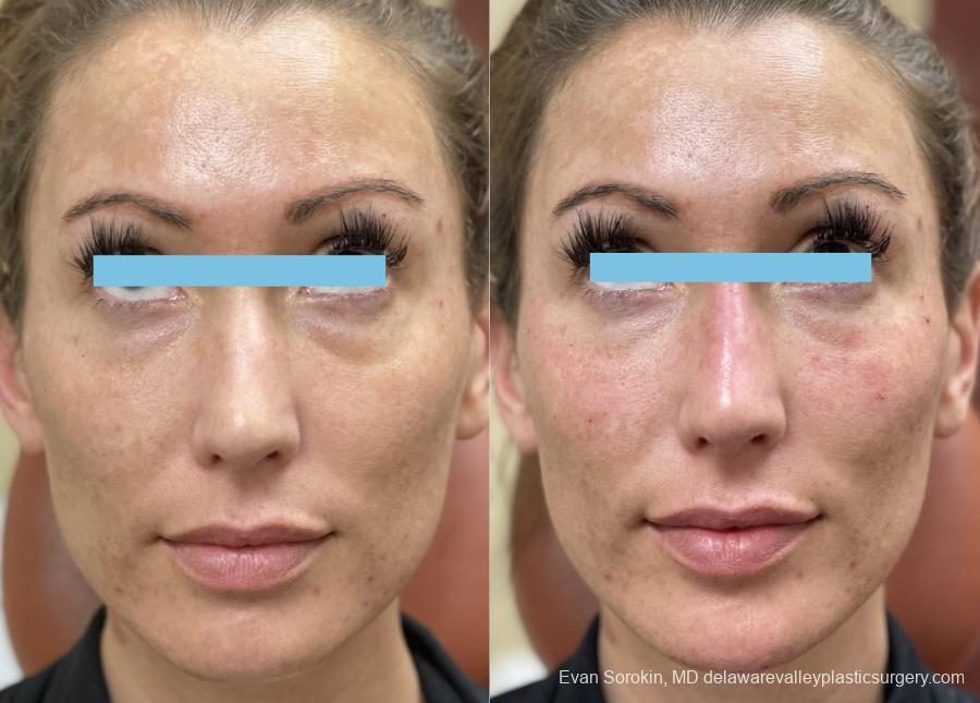 Fillers: Patient 12 - Before and After 2