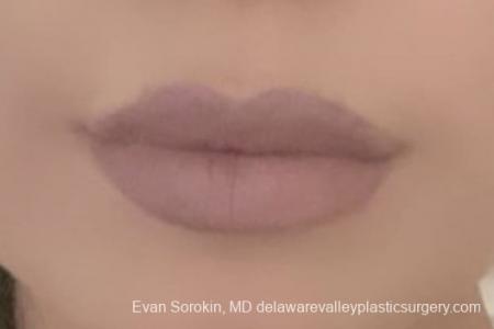 Lip Augmentation: Patient 6 - After Image 2