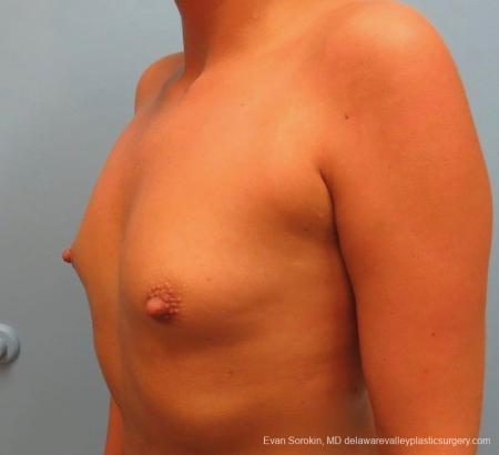 Philadelphia Breast Augmentation 8826 - Before Image 3