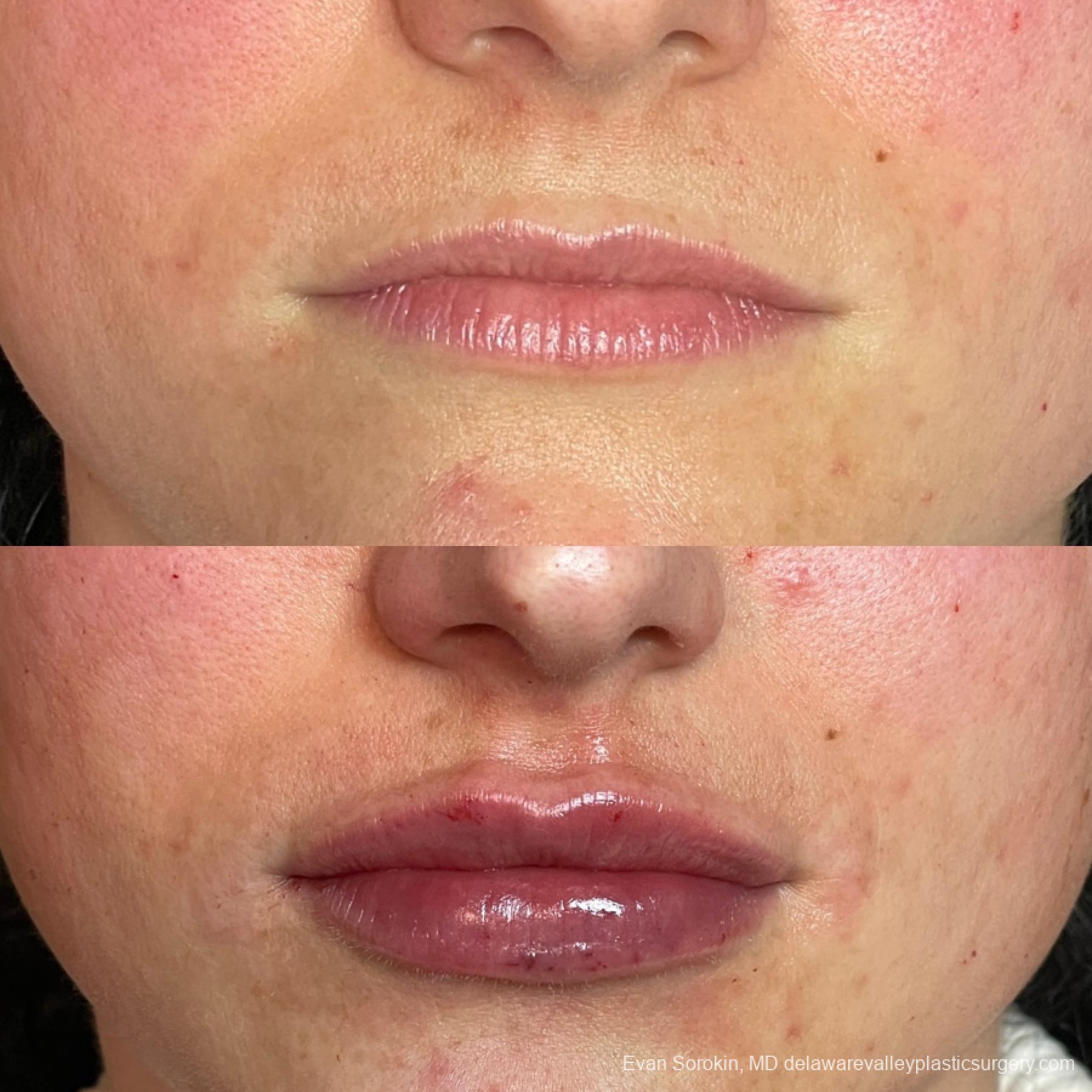 Fillers: Patient 40 - Before and After 