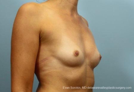 Philadelphia Breast Augmentation 8764 - Before Image 2