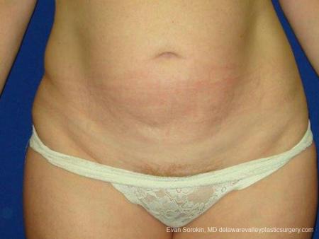 Philadelphia Abdominoplasty 9474 - Before Image 1