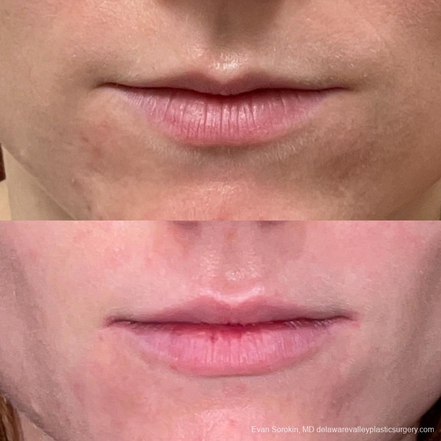 Lip Filler: Patient 19 - Before and After 1