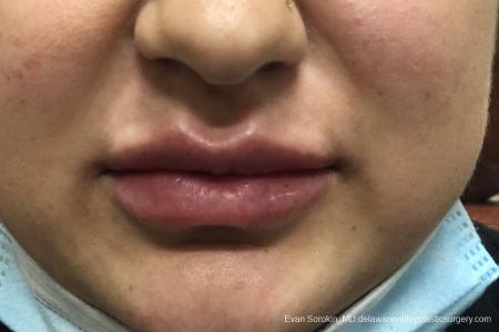 Lip Augmentation: Patient 14 - After Image 1