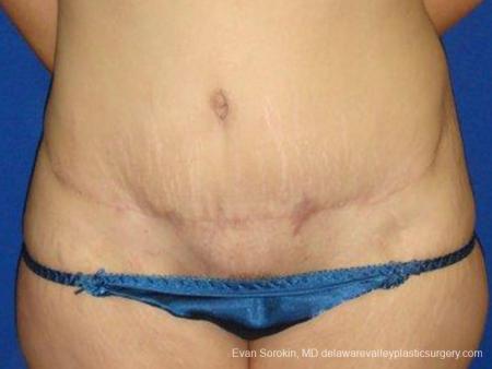 Philadelphia Abdominoplasty 9473 - After Image 1