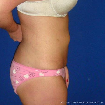 Philadelphia Liposuction 9484 - After Image 4