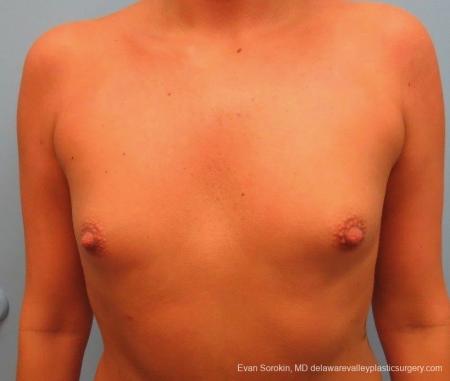 Philadelphia Breast Augmentation 8826 - Before Image 1