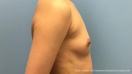 Philadelphia Breast Augmentation 13172 - Before Image 3
