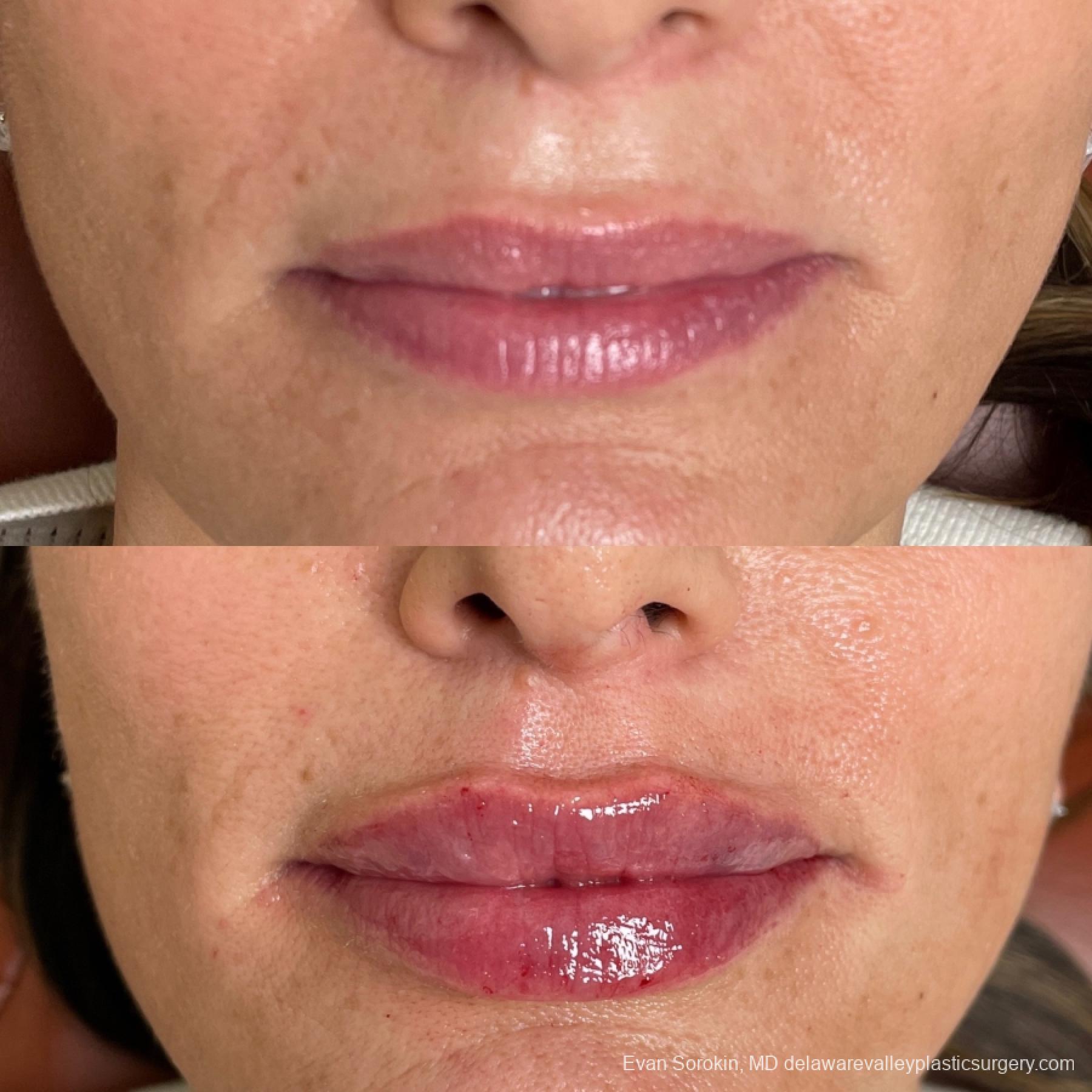 Lip Augmentation: Patient 60 - Before and After 1