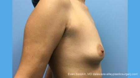 Breast Augmentation: Patient 137 - Before and After Image 5
