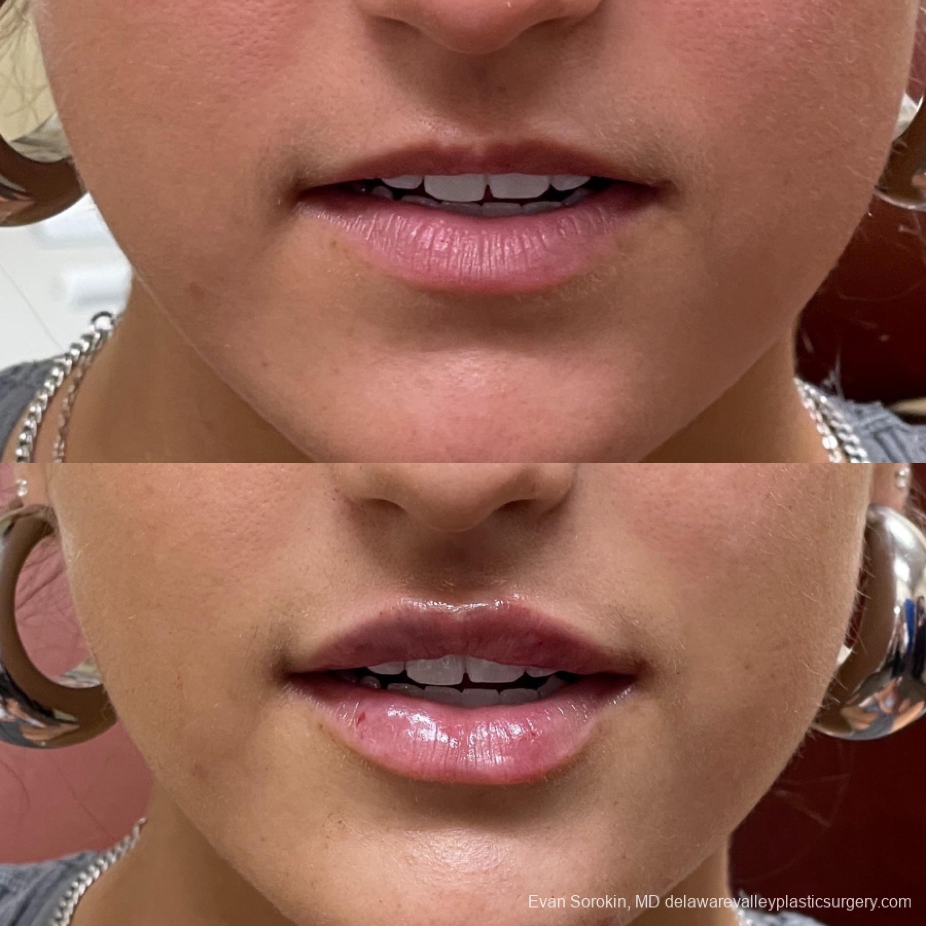 Lip Filler: Patient 41 - Before and After 1