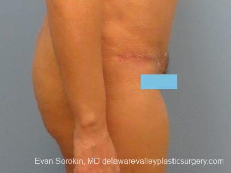 Philadelphia Abdominoplasty 8672 - After Image 5