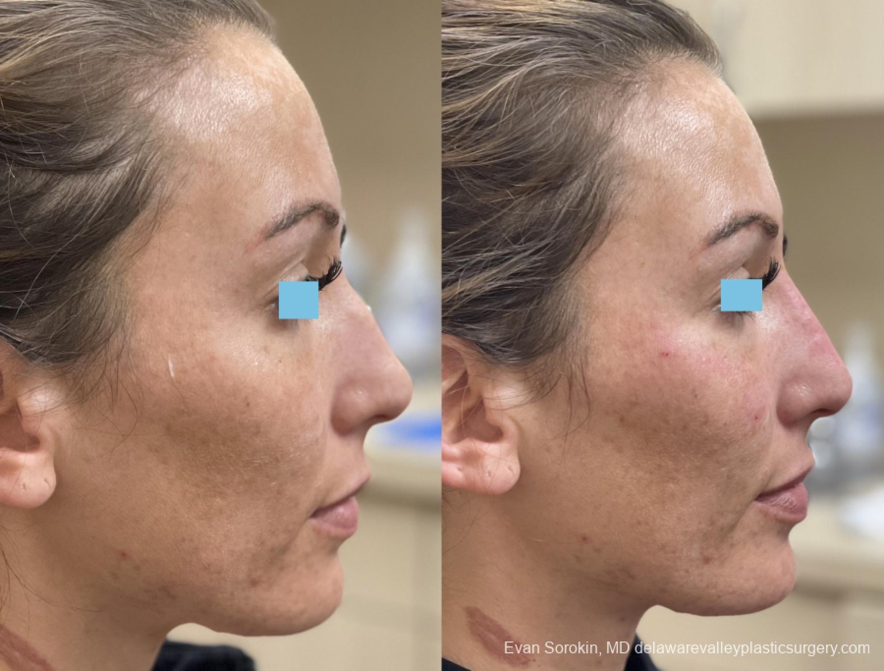 Fillers: Patient 12 - Before and After 4