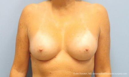 Philadelphia Breast Augmentation 9600 - After Image 1