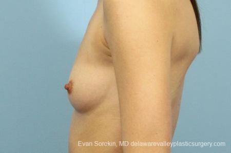 Philadelphia Breast Augmentation 8660 - Before and After Image 5