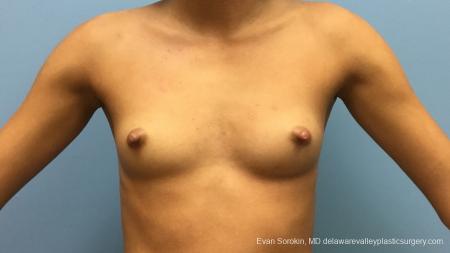 Philadelphia Breast Augmentation 13176 - Before Image 1