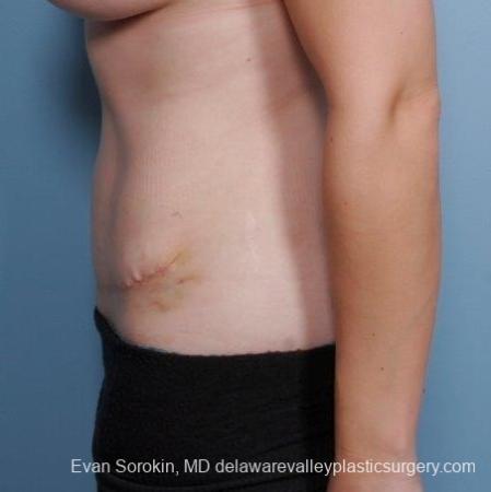 Philadelphia Abdominoplasty 8681 - After Image 5