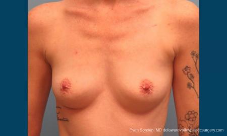 Philadelphia Breast Augmentation 9371 - Before Image 1