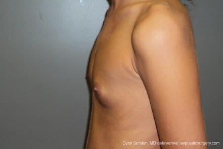 Philadelphia Breast Augmentation 8668 - Before and After Image 5