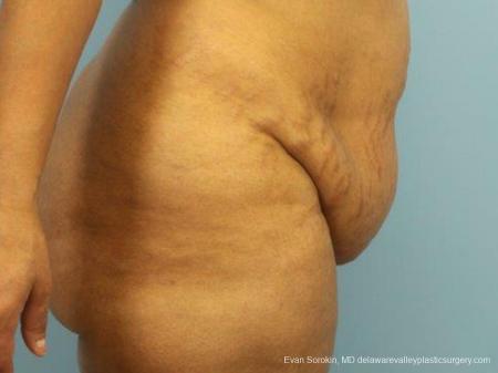 Philadelphia Abdominoplasty 9462 - Before Image 3