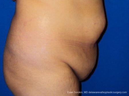 Philadelphia Abdominoplasty 9471 - Before Image 3