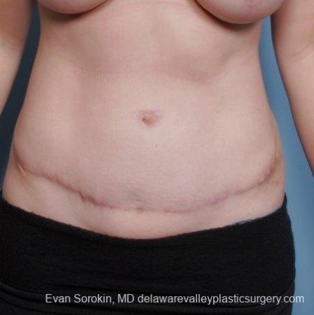 Philadelphia Abdominoplasty 8681 - After Image 1