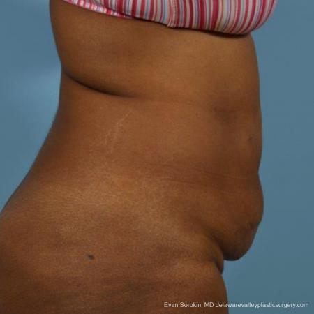 Philadelphia Abdominoplasty 9472 - Before Image 3