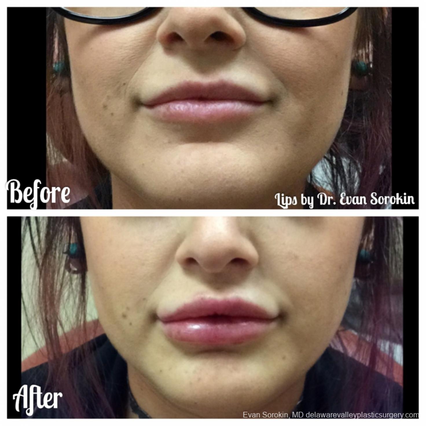 Lip Augmentation: Patient 36 - Before and After 