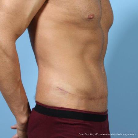 Philadelphia Abdominoplasty 9468 - After Image 2