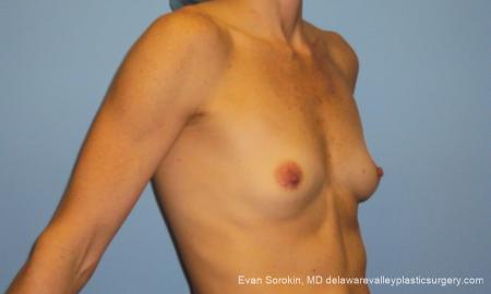 Philadelphia Breast Augmentation 10248 - Before Image 2