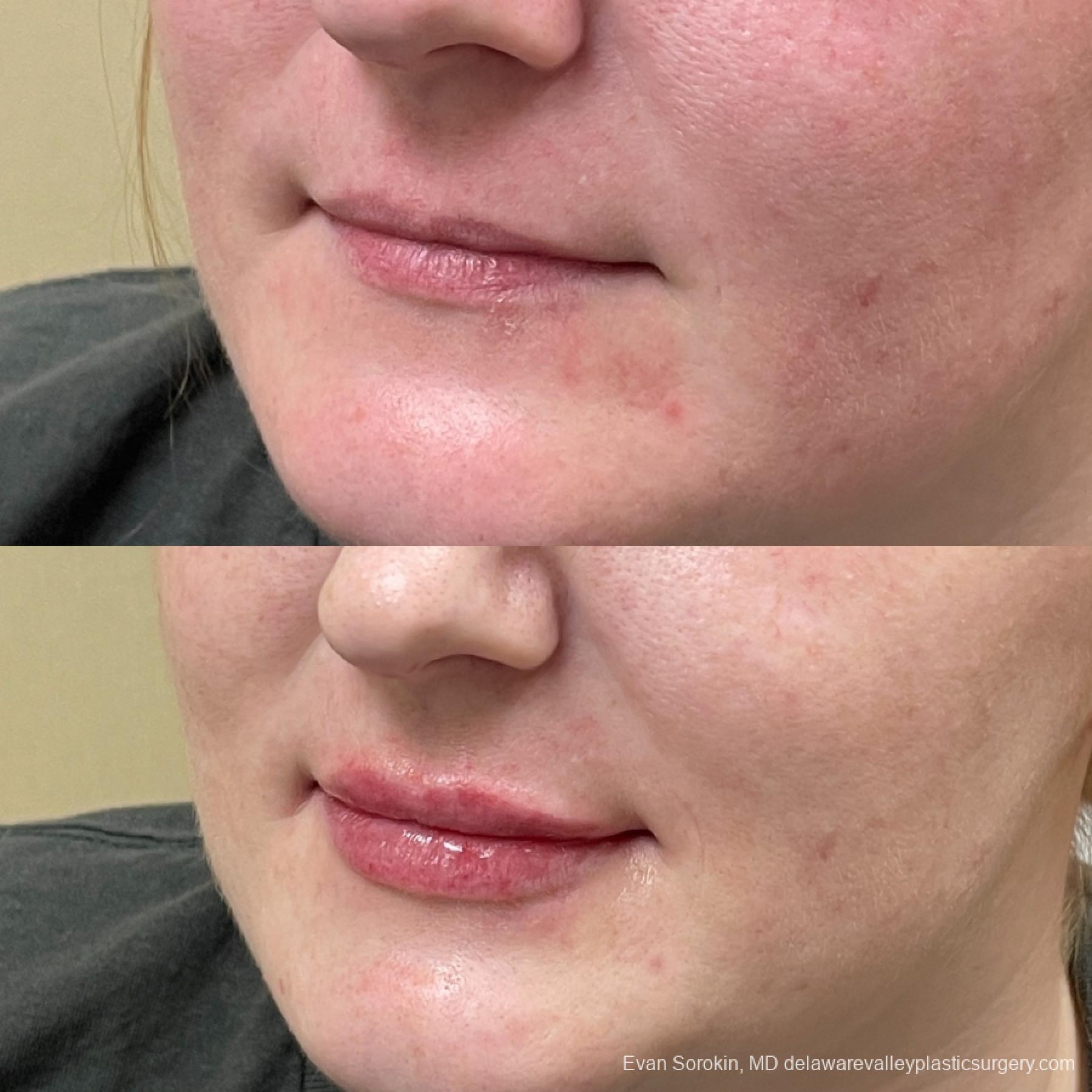 Lip Filler: Patient 11 - Before and After 3