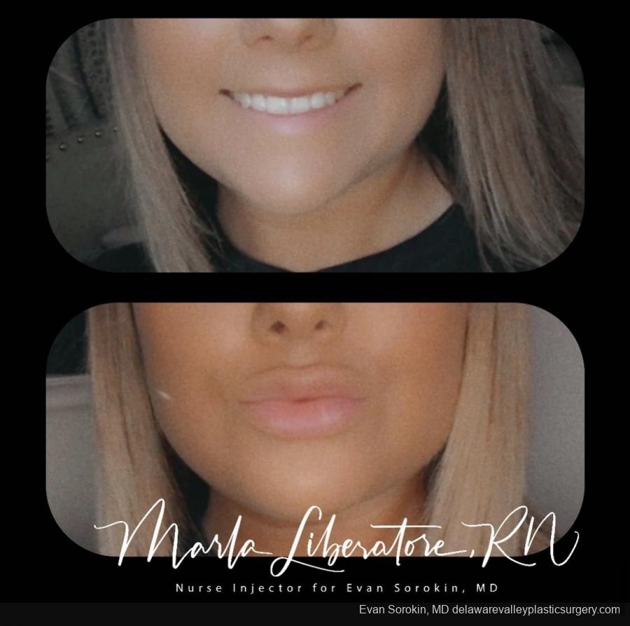 Lip Augmentation: Patient 21 - Before and After Image 1