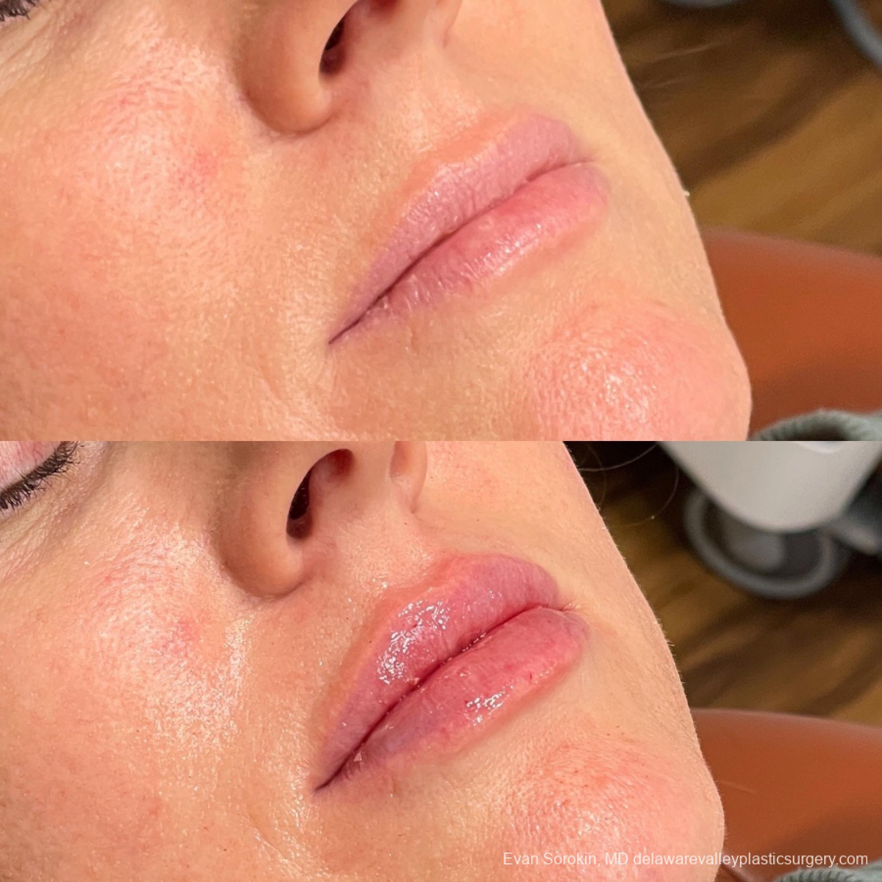 Lip Augmentation: Patient 65 - Before and After 2