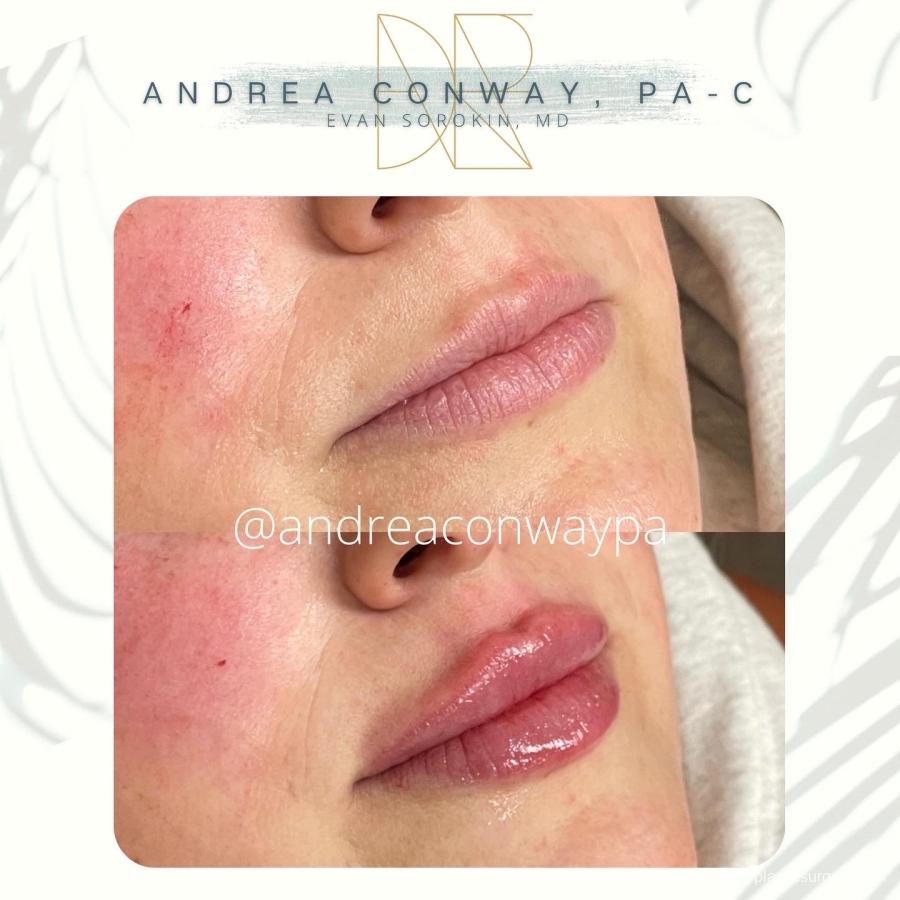 Lip Filler: Patient 15 - Before and After 2