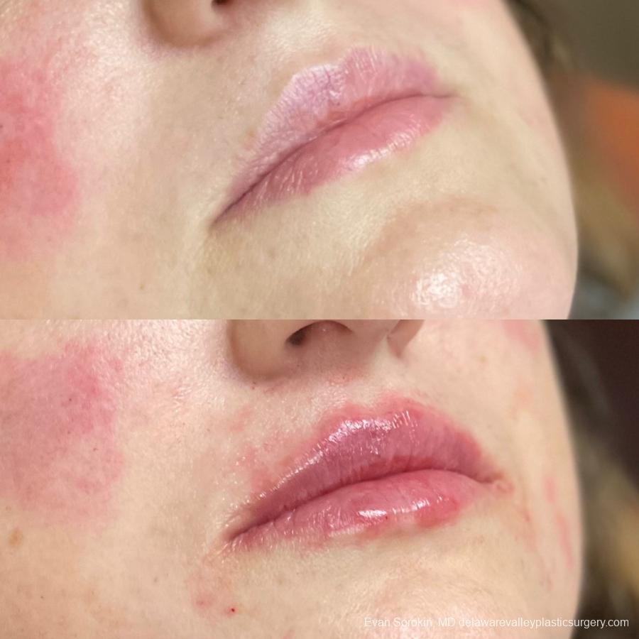 Lip Filler: Patient 26 - Before and After 2